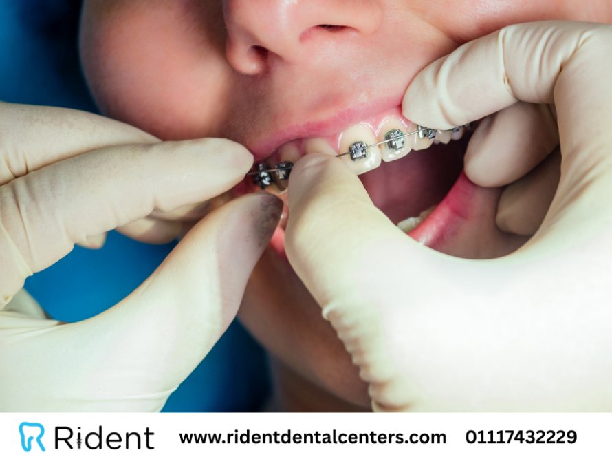 سعر تقويم الاسنان الفك العلوي فقط