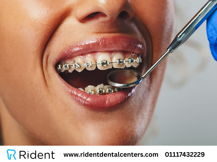 شروط تركيب تقويم الأسنان :هل تقويم الاسنان يؤثر على العلاقة الزوجية؟