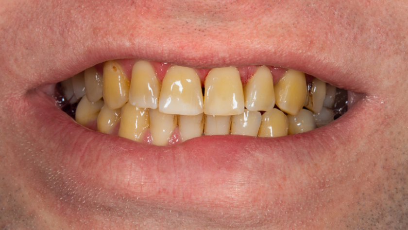 علاج اصفرار الاسنان أو تصبغات الاسنان بـ9 طرق