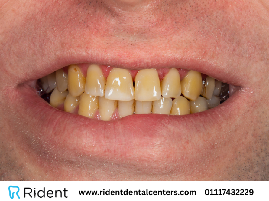 علاج اصفرار الاسنان أو تصبغات الاسنان بـ9 طرق