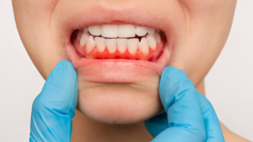 علاج التهاب اللثة بـ 3 طرق ونصائح هامة