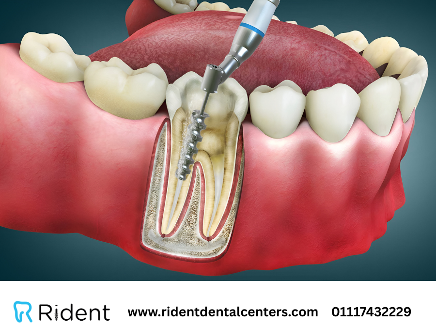 تاكل جذور الاسنان .. عادات يومية قد تؤدي إلى فقدان الأسنان في نهاية المطاف