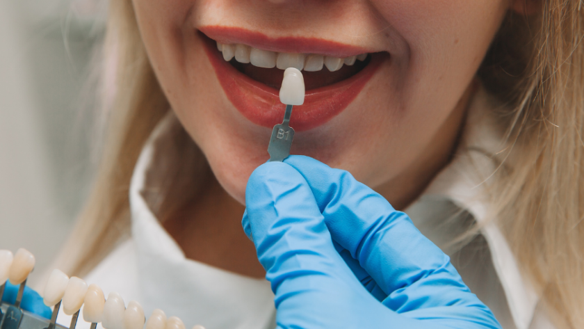 علاج تسوس الاسنان الامامية بالحشو والفينير في 4 خطوات