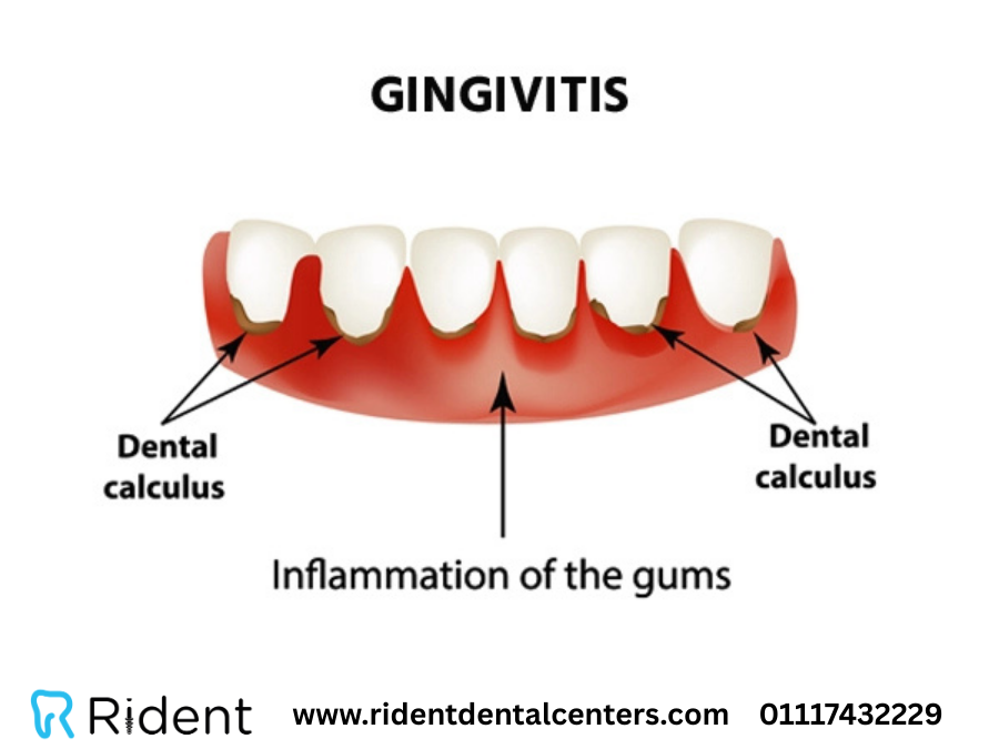 علاج حساسية الاسنان بحشو العصب نهائياً في 3 خطوات