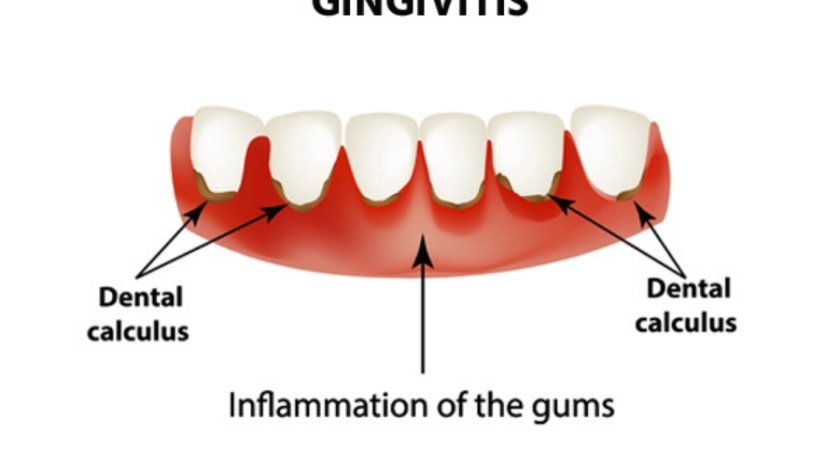 علاج حساسية الاسنان بـ 4 طرق مختلفة