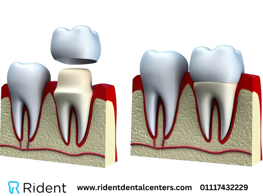 عيوب طربوش الأسنان