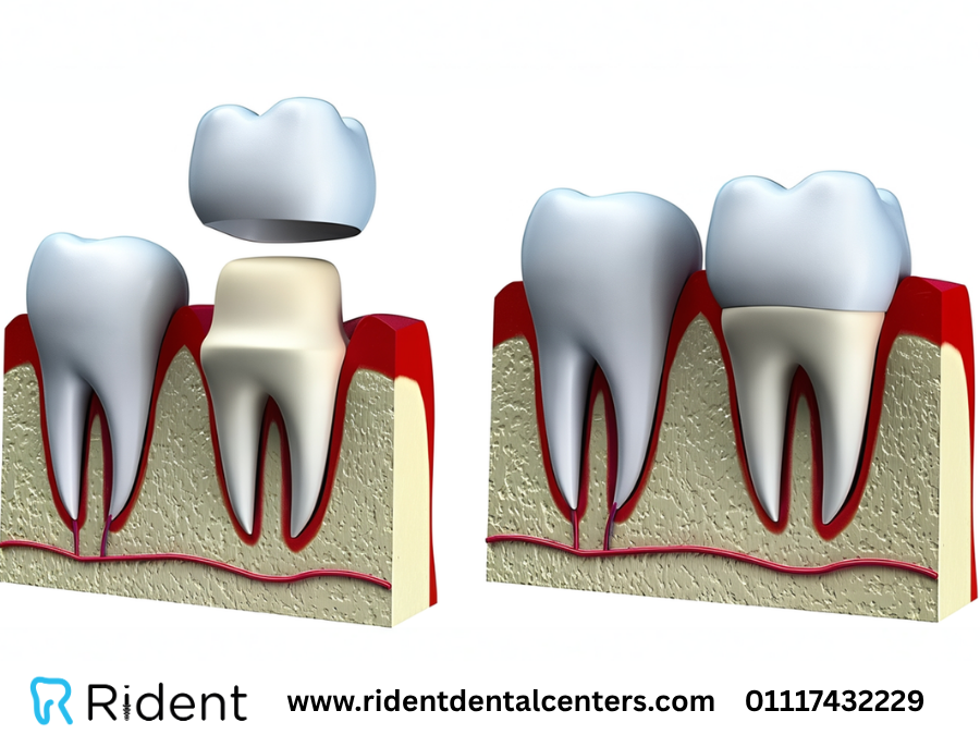 عيوب طربوش الأسنان