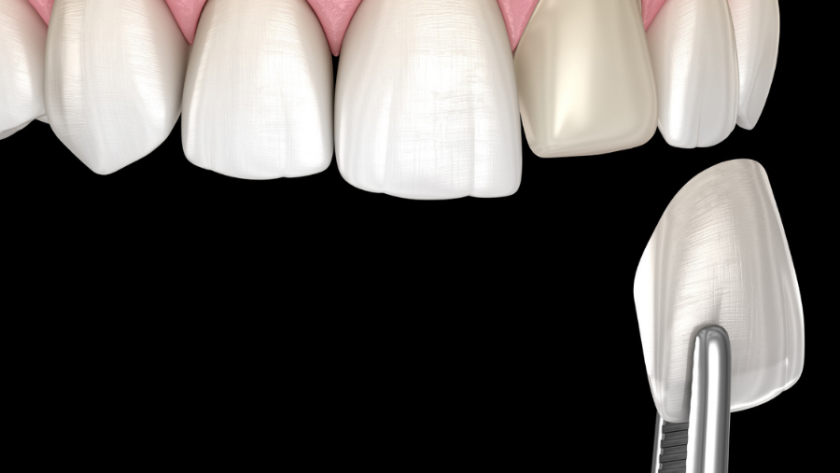 فينير الاسنان