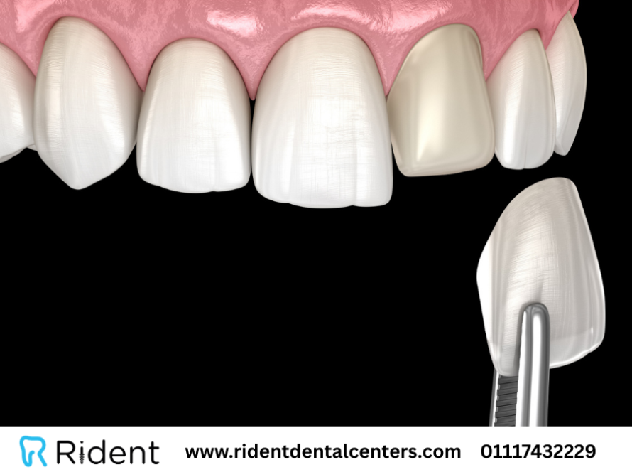 فينير الاسنان