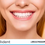 فينير الاسنان