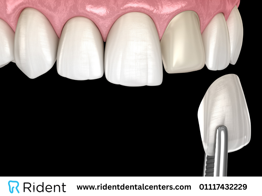 فينير الاسنان