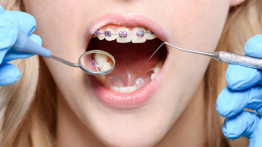 كل ما تريد معرفته حول تكنولوجيا تقويم الاسنان الجديدة