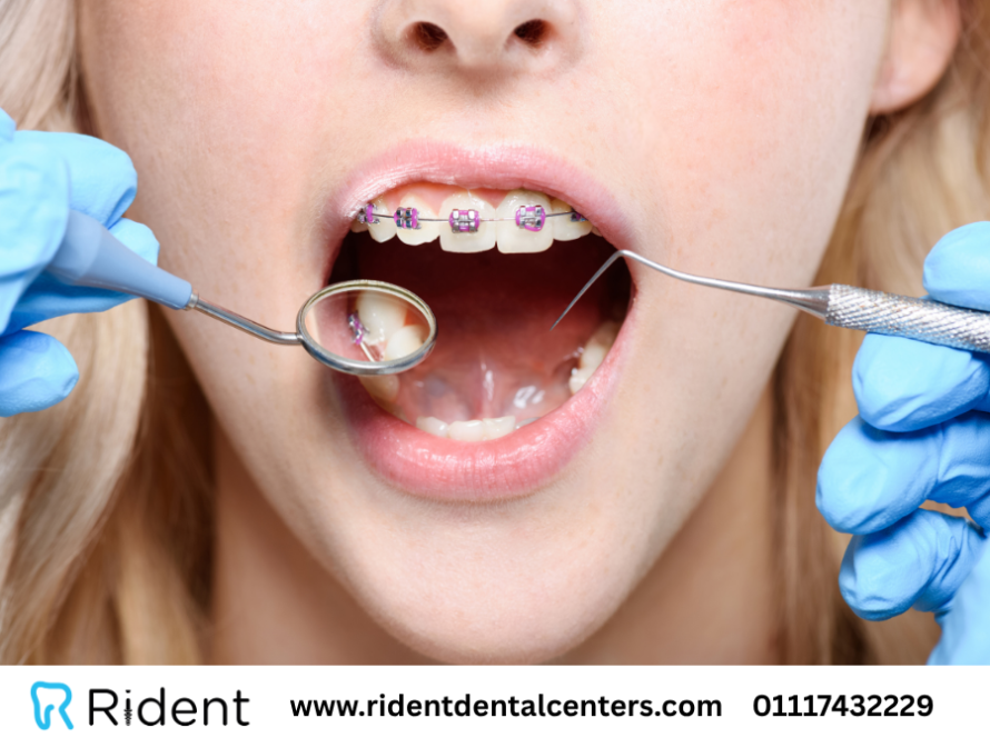 كل ما تريد معرفته حول تكنولوجيا تقويم الاسنان الجديدة