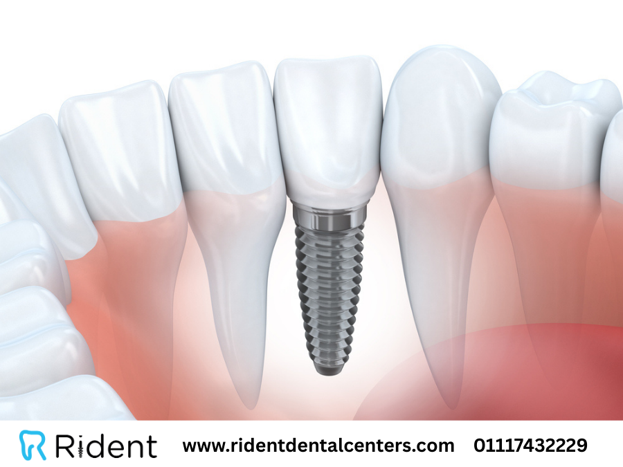 مشاكل تركيبات الأسنان
