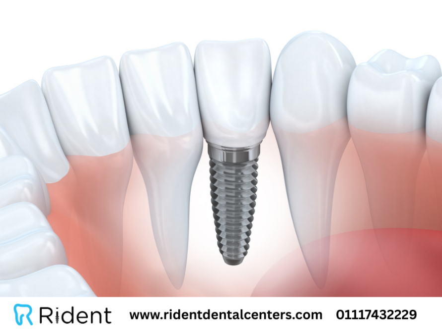 زراعة الأسنان بدون جراحة 2025