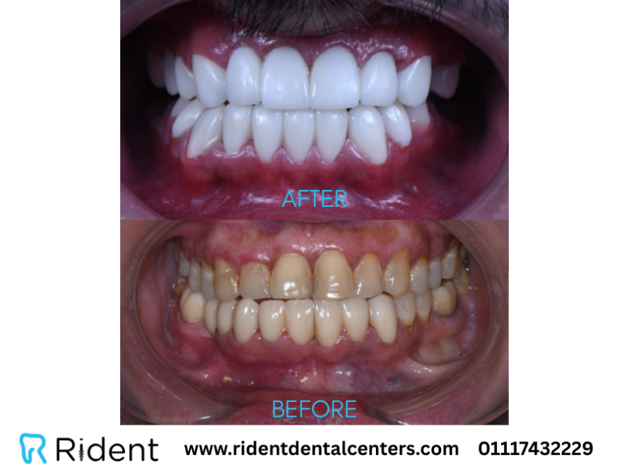 ما هو الفينير