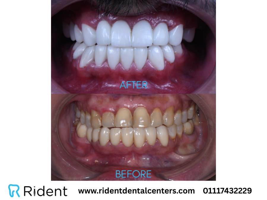 ما هو الفينير