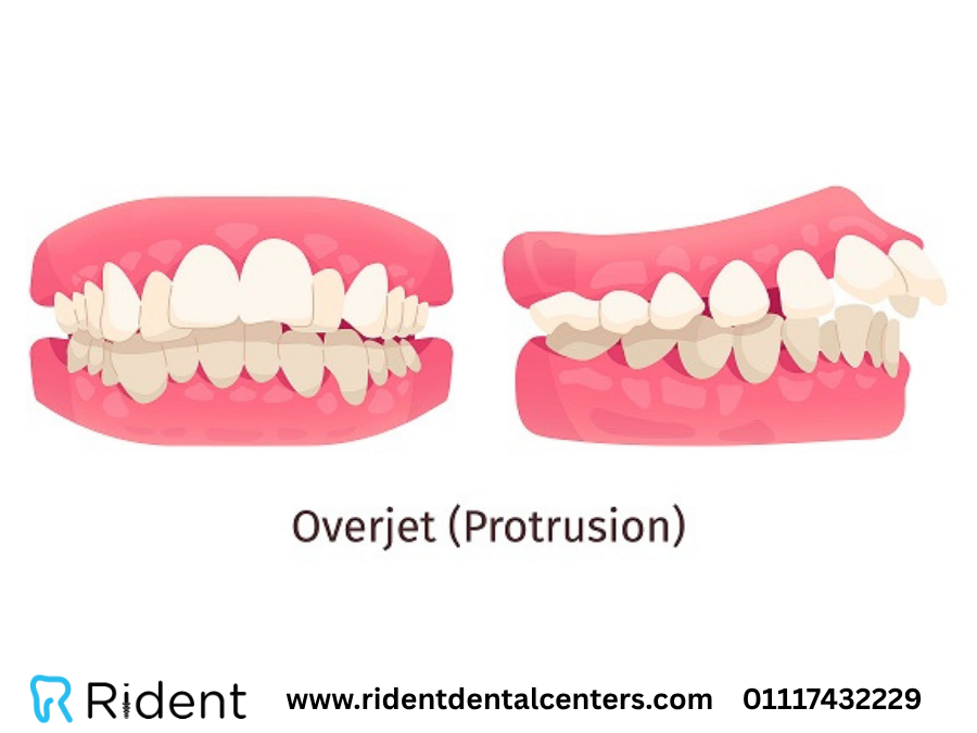 مدة تقويم الأسنان البارزة و8 أنواع مختلفة للتقويم لا تعلمها