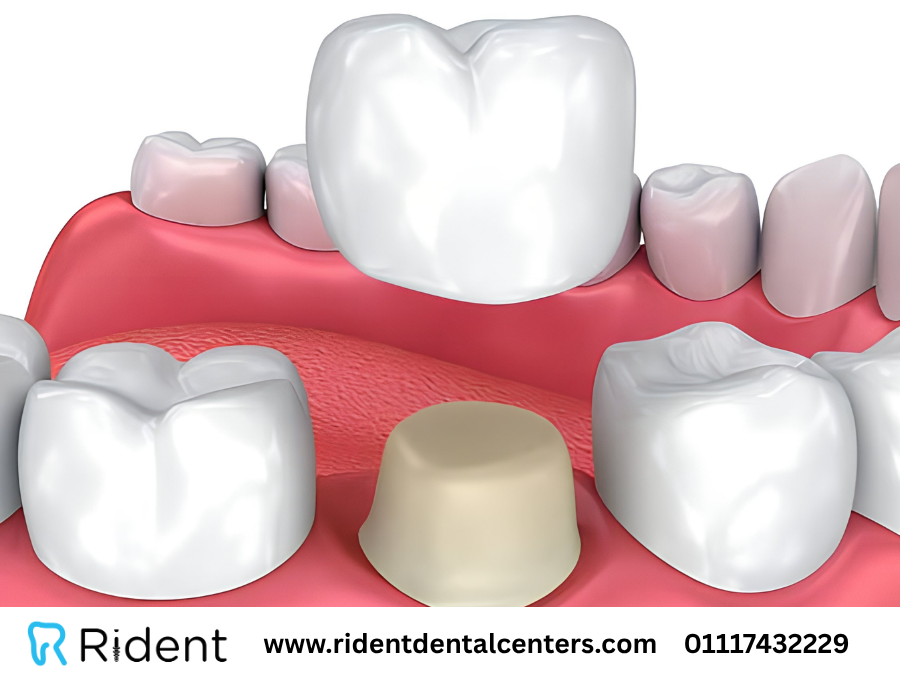 نظام الاكل بعد تركيب الطربوش