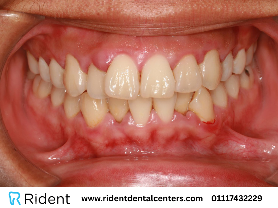 هل التهاب اللثة يسبب ألم الأسنان؟