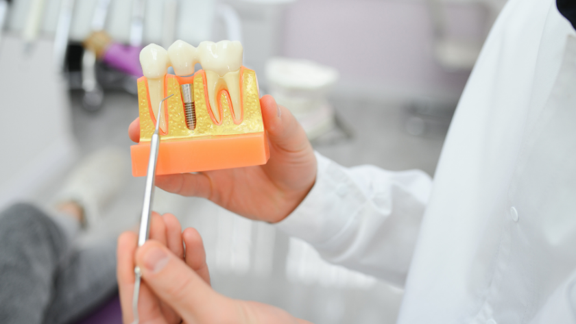 أسعار زراعة الأسنان في مصر 2025