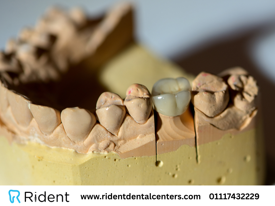 هل طربوش الأسنان دائم