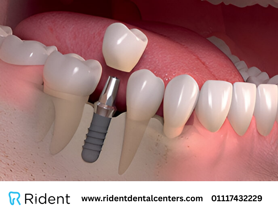 طريقة تركيب اسنان زيركون